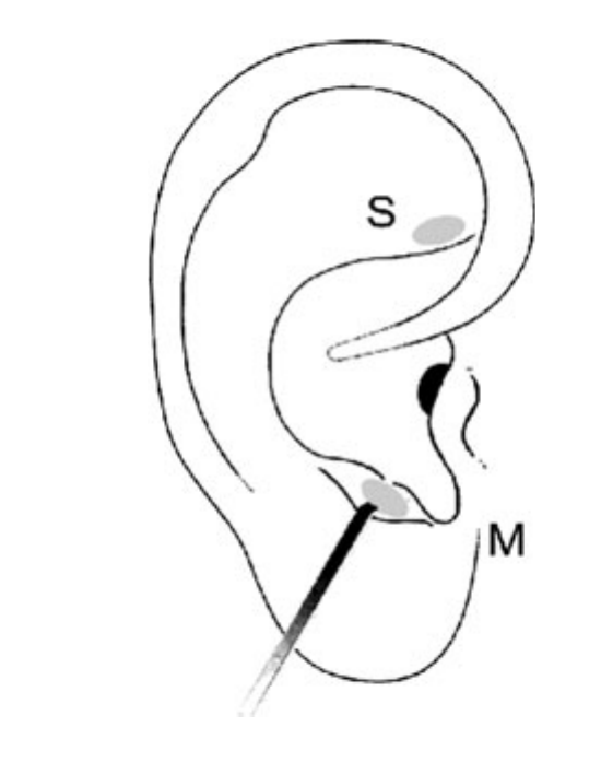 Figure from the original paper displaying the appropriate area (M) versus the inappropriate area (S) used in the treatment of migraine attacks.